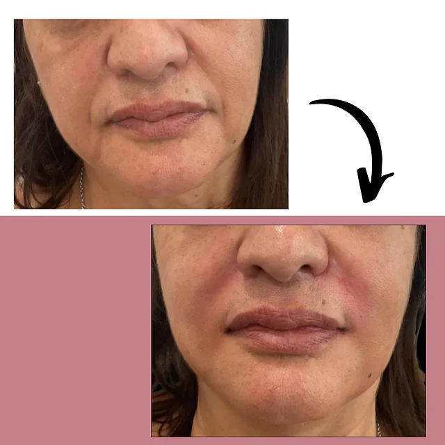 Caso fotográfico de Rellenos Faciales, imagen comparativa 1