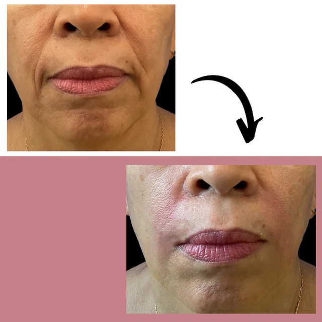 Caso fotográfico de Rellenos Faciales, imagen comparativa 2