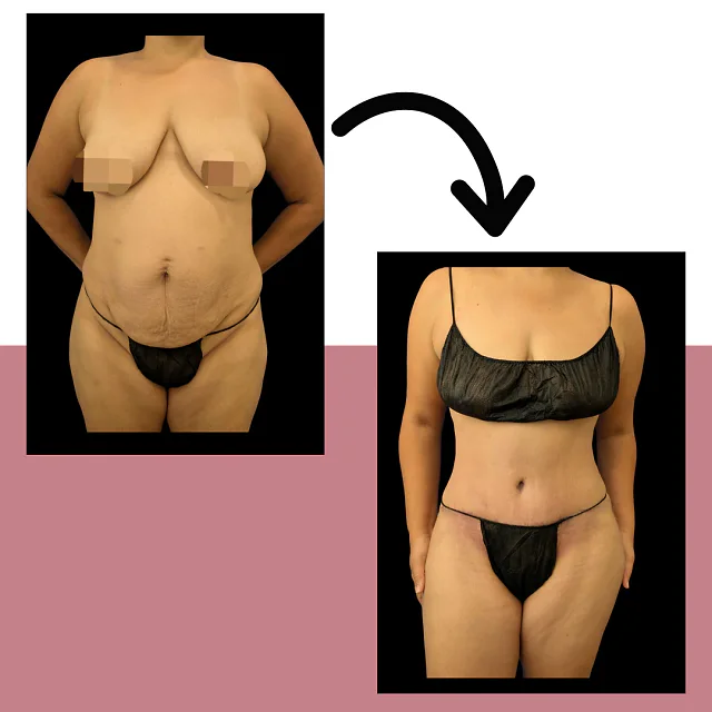 Caso fotográfico de Abdominoplastia, imagen comparativa 1