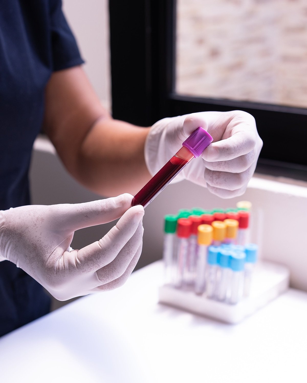 Manos con guantes sosteniendo una muestra de sangre para preparar plasma rico en plaquetas