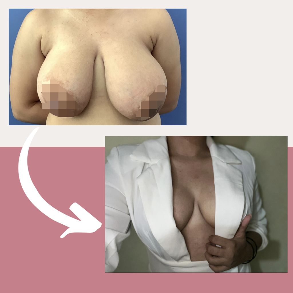 Breast lift/Levantamiento Mamário