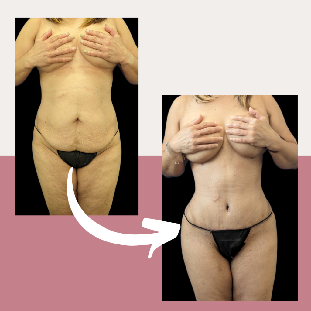 Abdominoplastia/Tummy Tuck